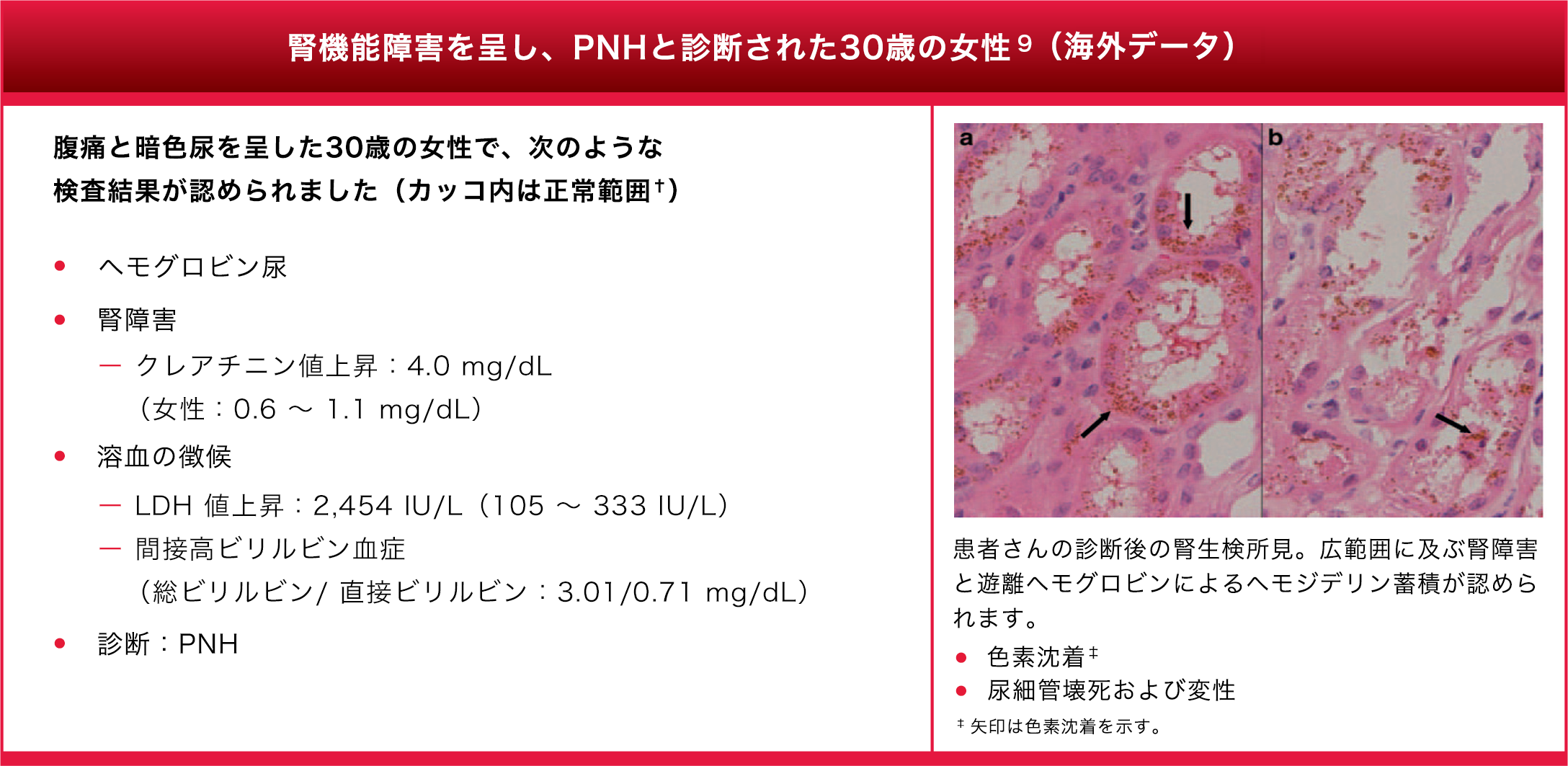 30-year-old woman presenting with renal dysfunction and diagnosed with PNH*34
