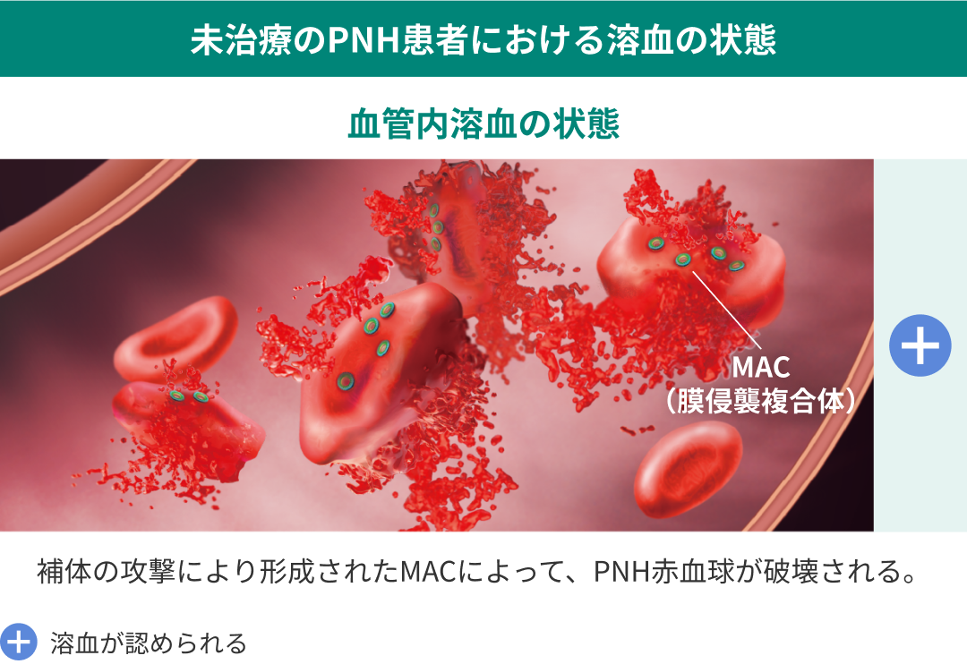 素敵でユニークな PNH医療関係者】発作性夜間ヘモグロビン尿症(PNH)の病態｜PNHSource 健康・医学